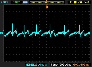 EKG signal captured by our module